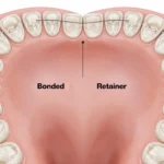 Permanent Retainer